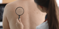 Câncer de pele: quais são os sintomas e como prevenir?