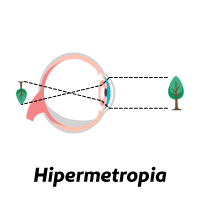 refração ocular - hipermetropia