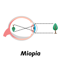 refração ocular - miopia