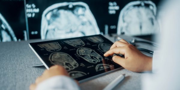 AVC: causas, diagnóstico e como prevenir o derrame cerebral