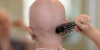 Alopecia: qual é a causa e como tratar a queda de cabelos?