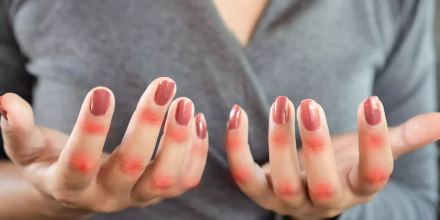 O que é lúpus: tipos, sintomas e tratamento da doença