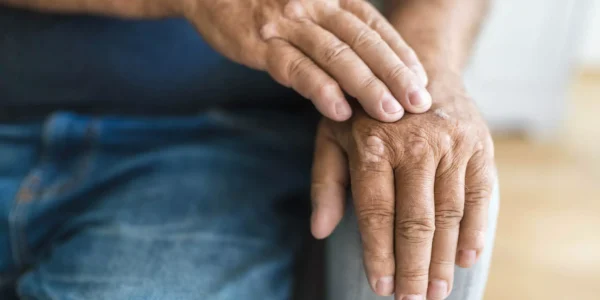 O que é psoríase: causas, sintomas e tratamento